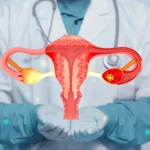 Endometriosis